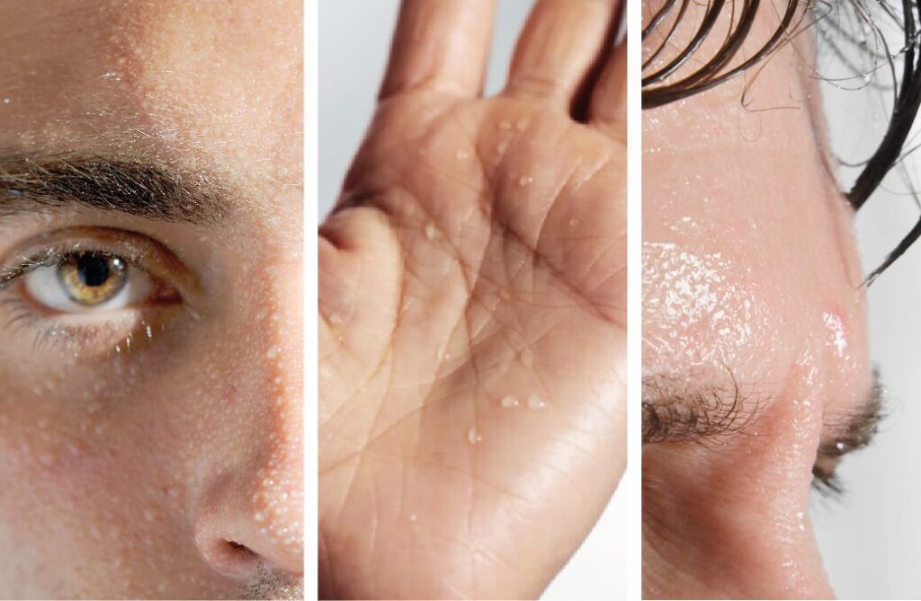 hiperhidrosis