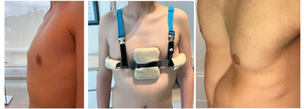 El pectus excavatum y el pectus carinatum son deformidades torácicas que afectan la estética y la salud, pero tienen tratamiento.
